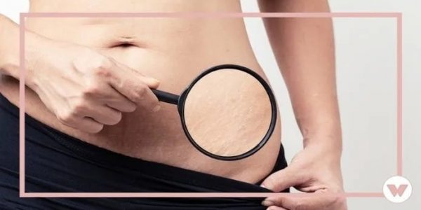 Stretch Mark Creams That Give the Longest-Lasting Results in 2023